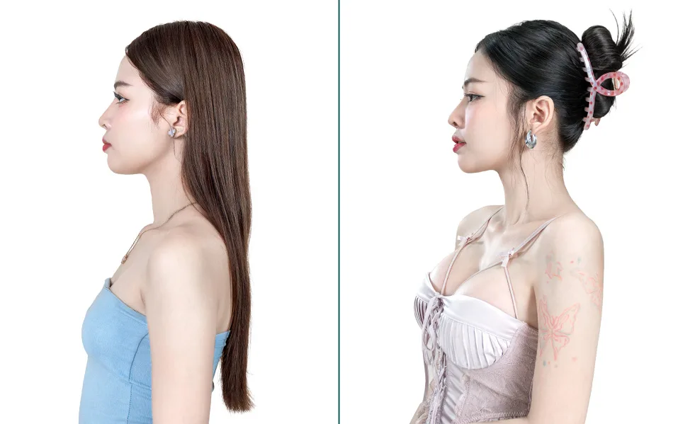 Breast Augmentation after treatment