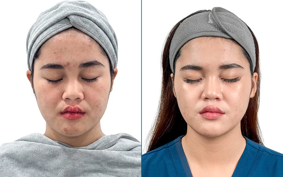 Danique Ultra after treatment