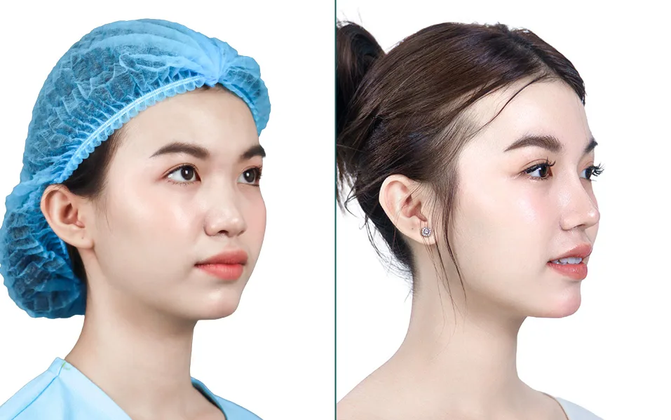 Rhinoplasty after treatment