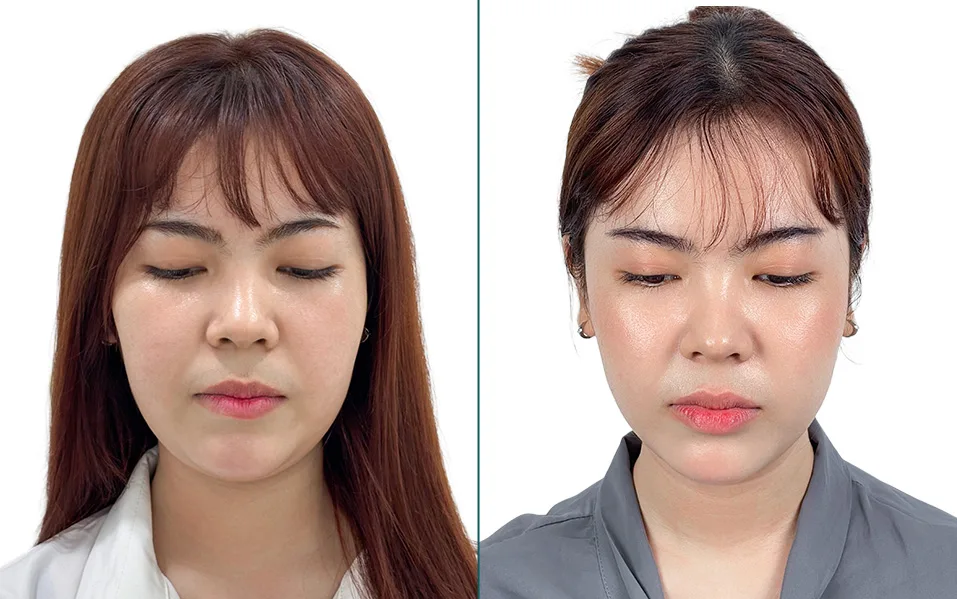 Miracle V Face after treatment