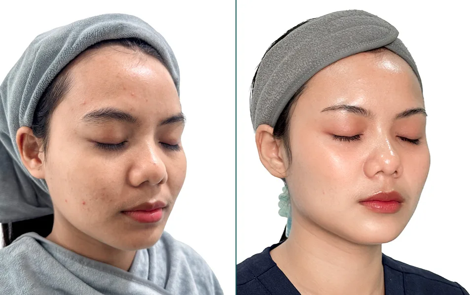 Danique Ultra before treatment