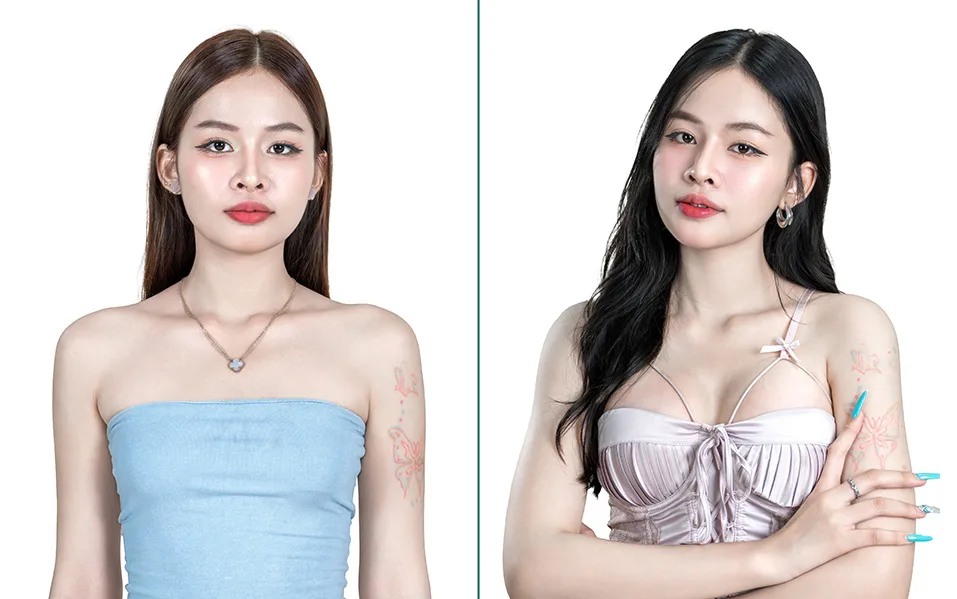 Breast Augmentation before treatment