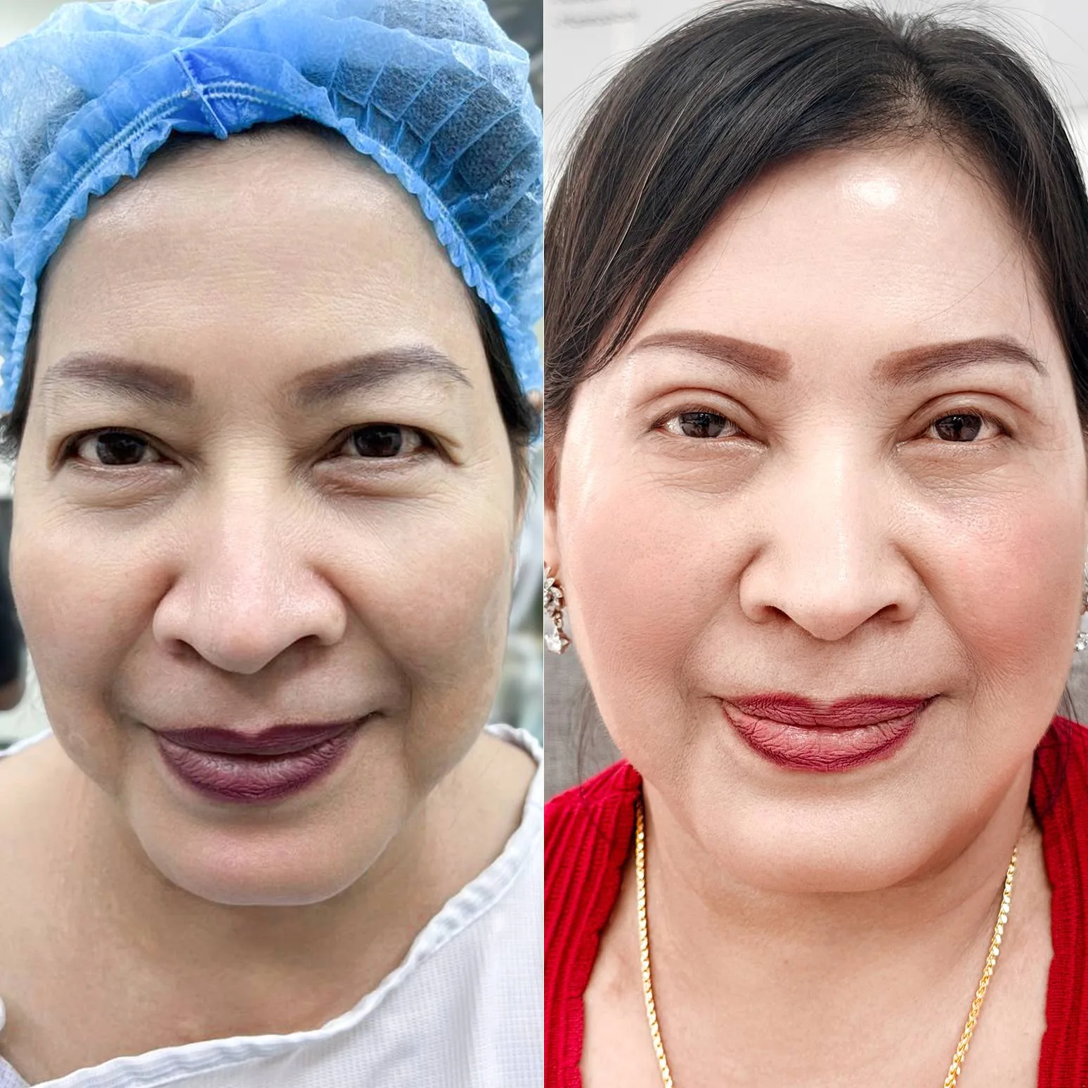 Eye Surgery